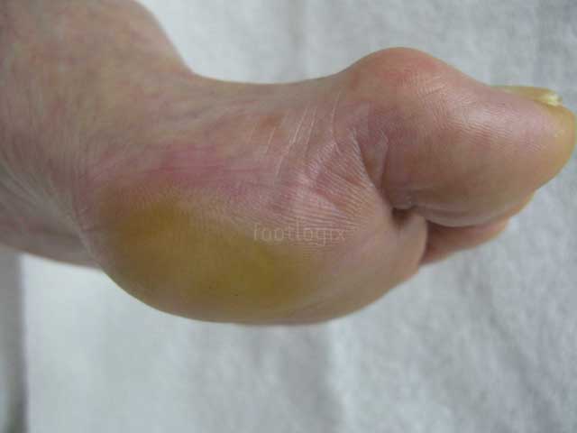 FOOTLOGIX CALLUS SOFTENER