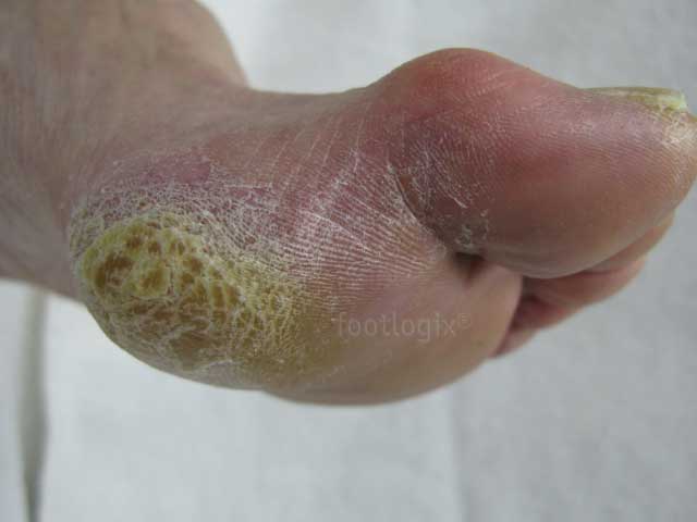 FOOTLOGIX CALLUS SOFTENER