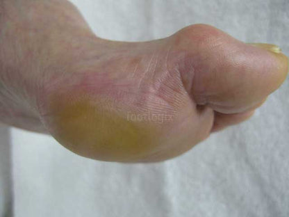 FOOTLOGIX CALLUS SOFTENER